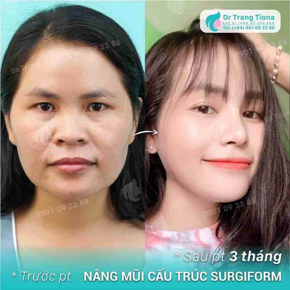 Nâng mũi cấu trúc duy trì hiệu quả bao lâu? 20 năm? 30 năm?