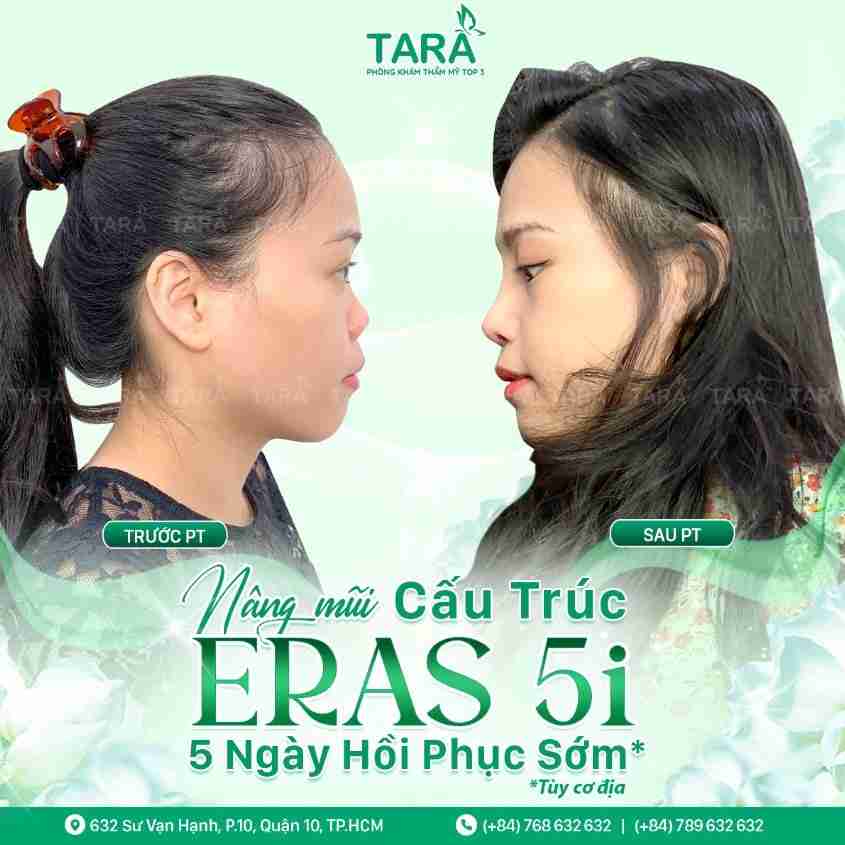 Nâng mũi cấu trúc ERAS 5i và những điều cần biết