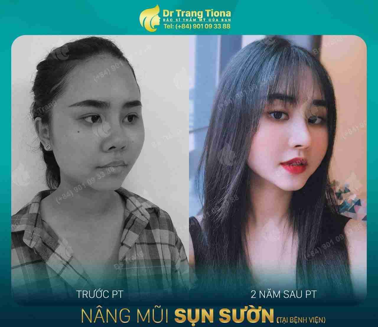 Nâng mũi có thay đổi khuôn mặt không?