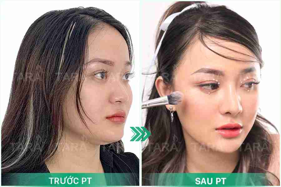 Nâng mũi hồi phục sớm 5 ngày – Nâng mũi ERAS 5i