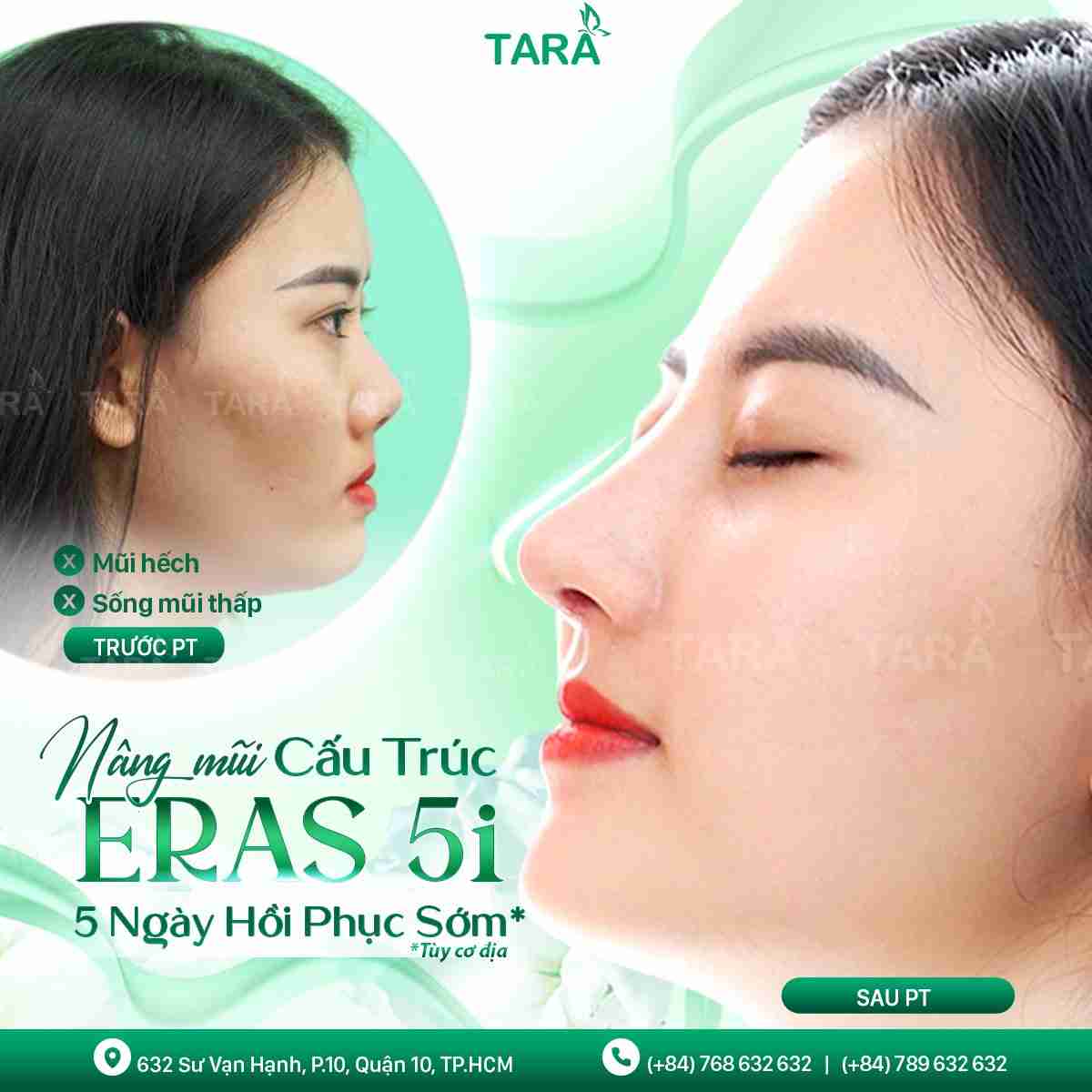 Nâng mũi ERAS 5i: Nâng mũi tháo nẹp sớm
