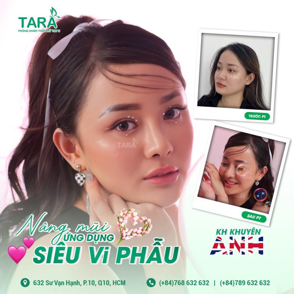 Nâng mũi không đau nhờ kỹ thuật ứng dụng kính lúp siêu vi phẫu
