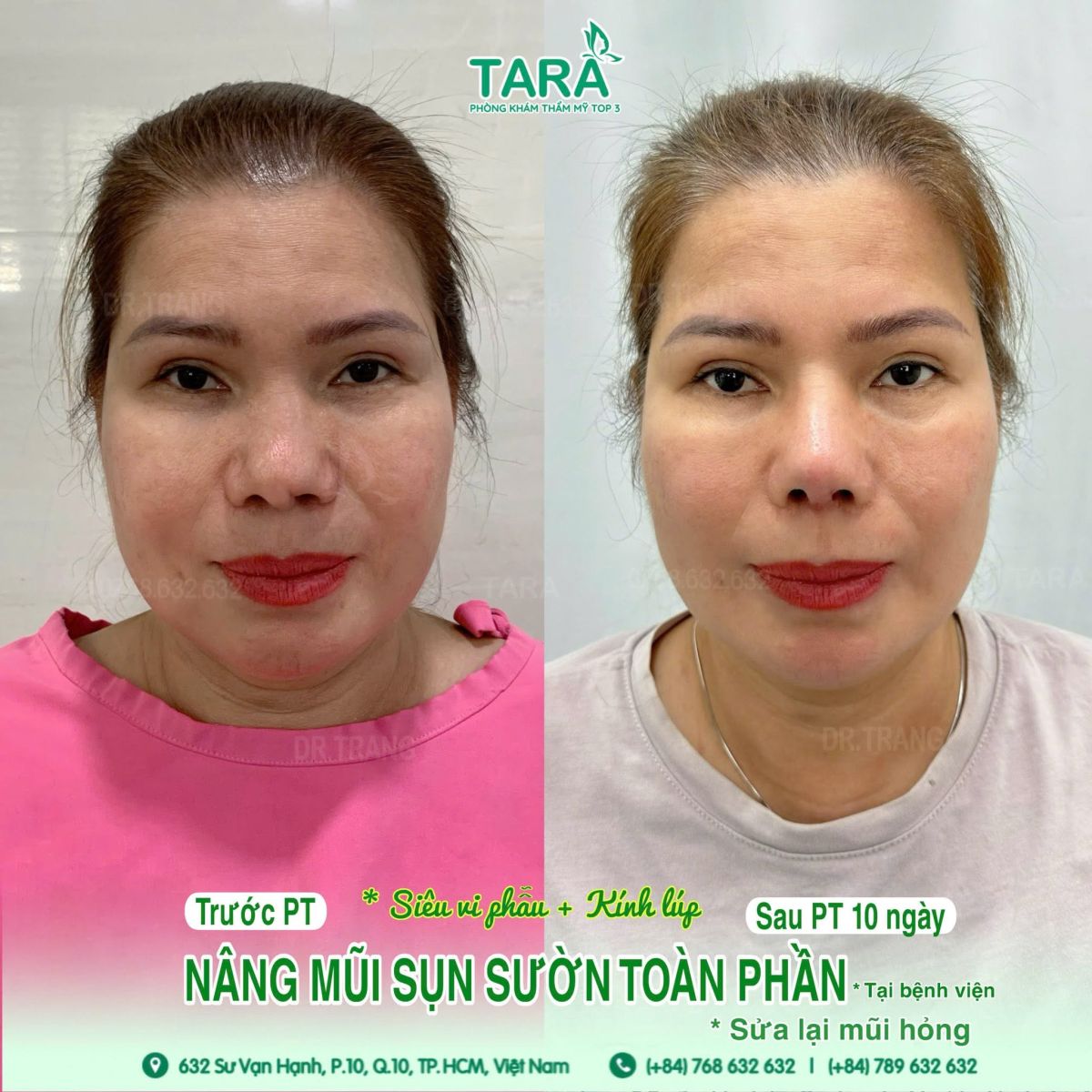 Nâng mũi không nẹp có phải kiêng nhiều không? Không có nẹp bảo vệ bên ngoài thì sụn có bị lệch không? Khi nào có thể đi làm, makeup hay đeo kính trở lại?