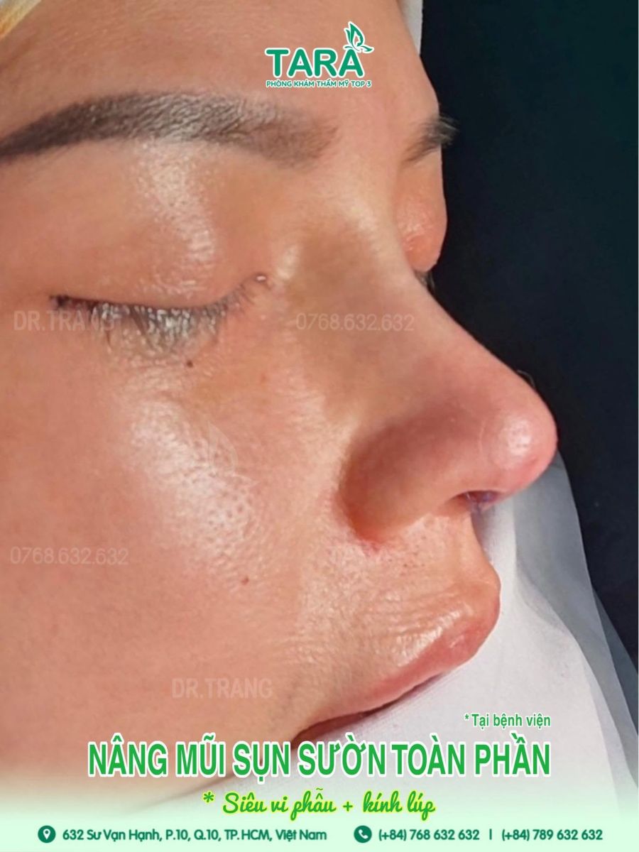 Nâng mũi không nẹp có phải kiêng nhiều không? Không có nẹp bảo vệ bên ngoài thì sụn có bị lệch không? Khi nào có thể đi làm, makeup hay đeo kính trở lại?