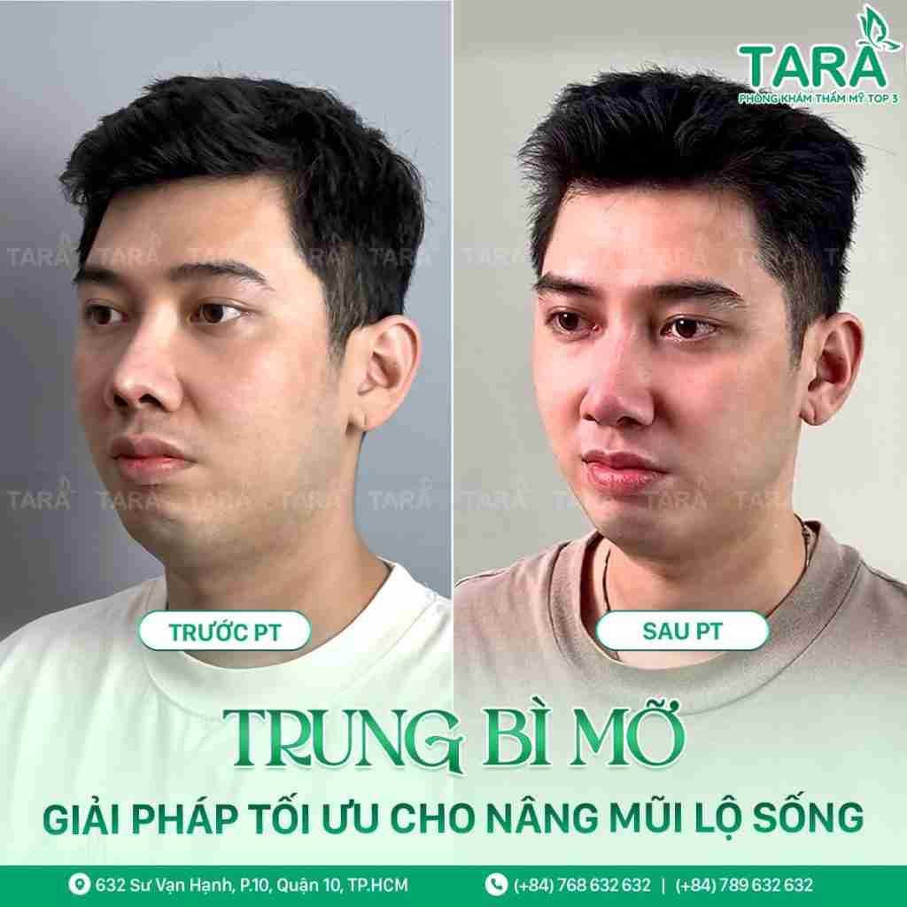 Nâng mũi mau lành – Phương pháp nâng mũi mau lành 5i