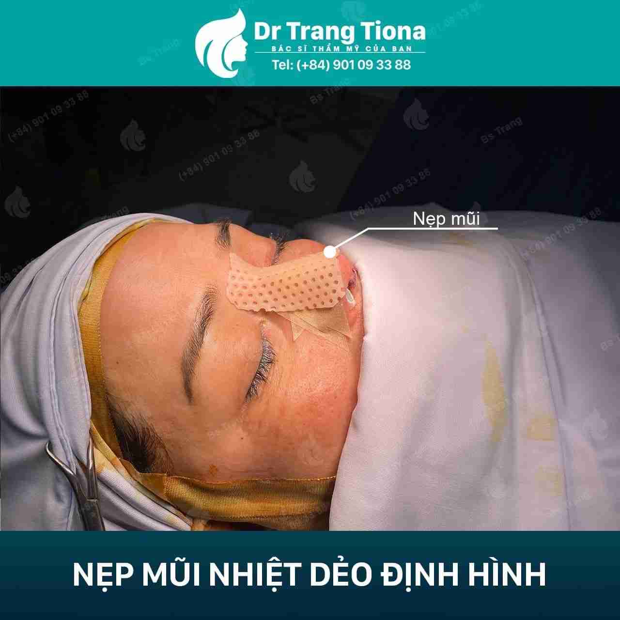 Nâng mũi sau 1 tháng có được chạy xe không?