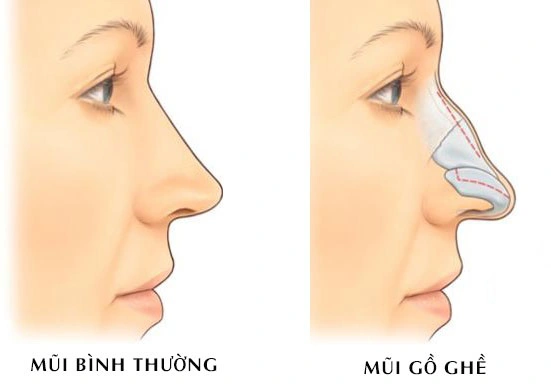 Nâng mũi siêu vi phẫu khắc phục mũi gồ để cao, đẹp hơn