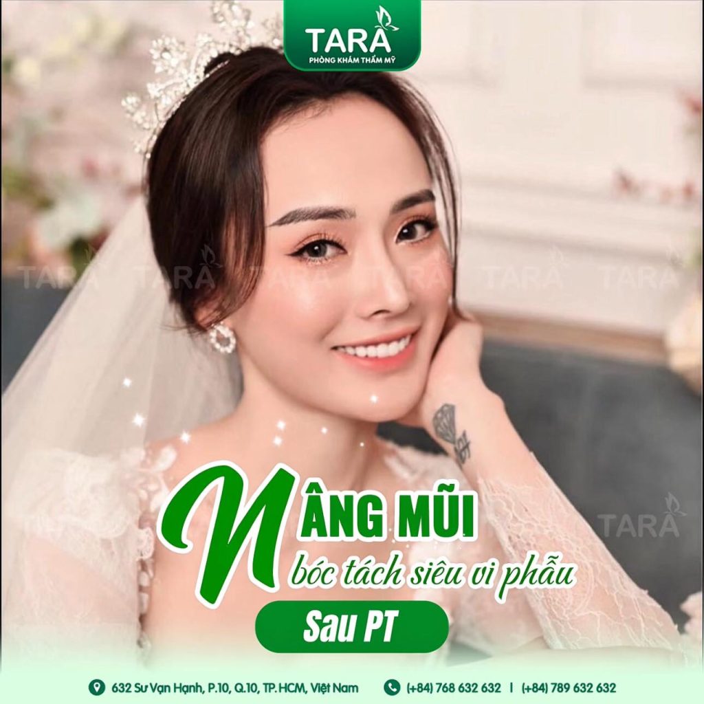 Nâng mũi siêu vi phẫu khắc phục mũi gồ để cao, đẹp hơn