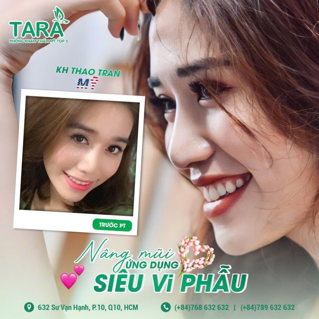 Nâng mũi siêu vi phẫu không nẹp cứng, 3 ngày vào form