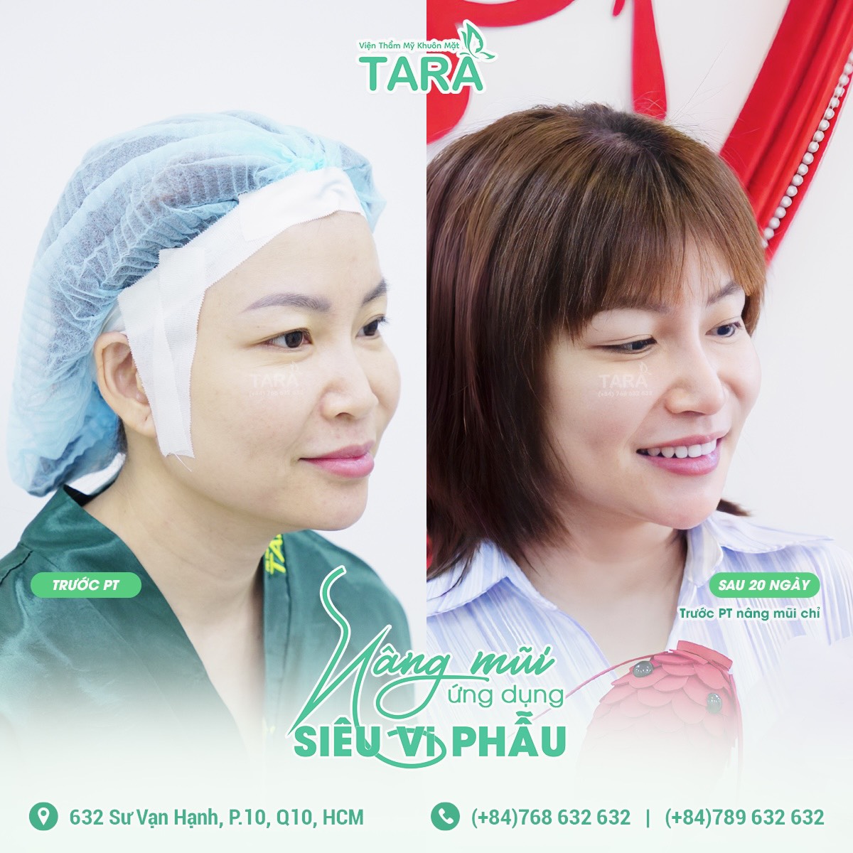 Nâng mũi ứng dụng đeo kính lúp siêu vi phẫu tại Sài Gòn: Địa chỉ uy nào uy tín?