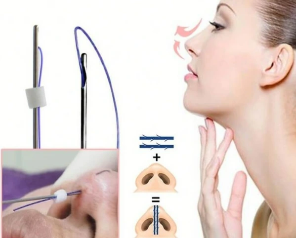So sánh nâng mũi siêu vi phẫu so với tiêm filler, nâng mũi chỉ