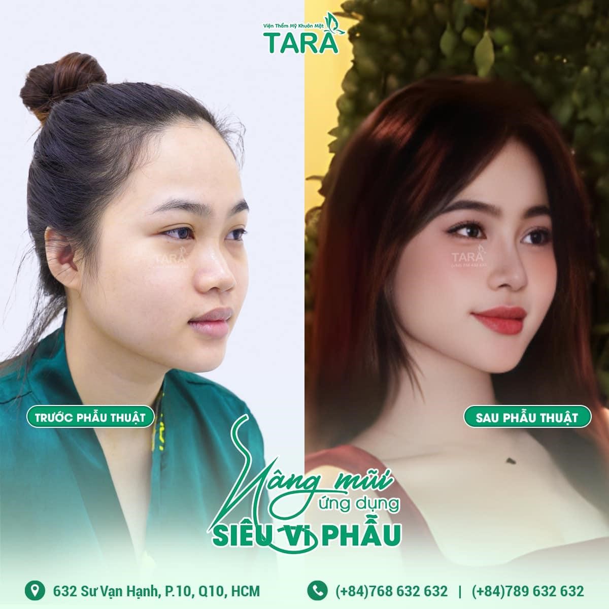 So sánh nâng mũi siêu vi phẫu so với tiêm filler, nâng mũi chỉ