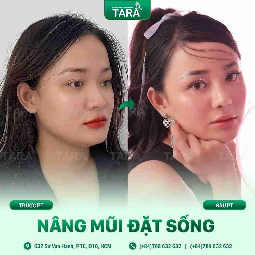 Nâng mũi sụn nhân tạo – Bí quyết sở hữu dáng mũi hoàn hảo
