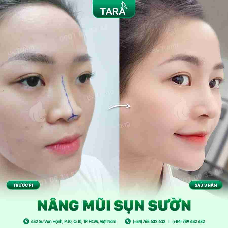 Nâng mũi sụn sườn có cần nghỉ dưỡng không?