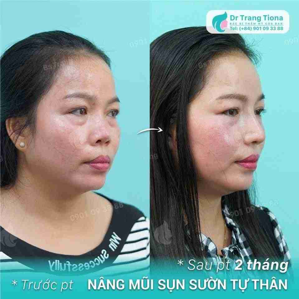 Nâng mũi sụn sườn có đau không? Cần gây mê hay gây tê?