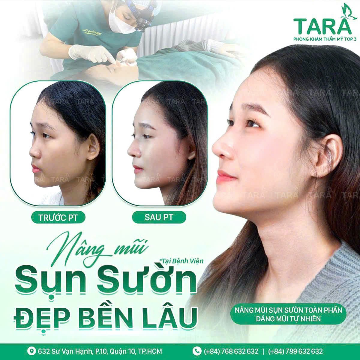 Nâng mũi sụn tự thân bao lâu thì đi làm được?