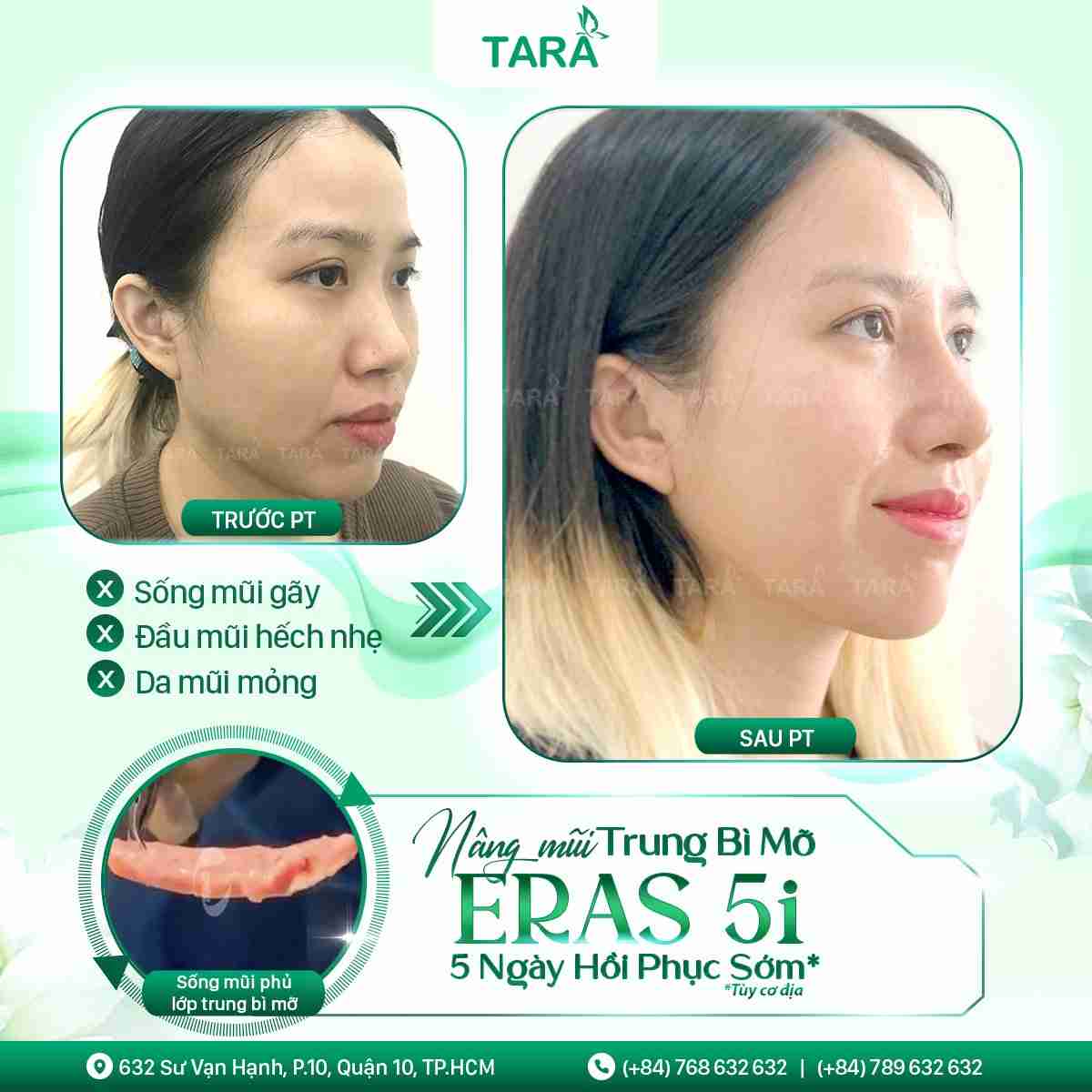Nâng mũi trung bì mỡ ERAS 5i là gì?