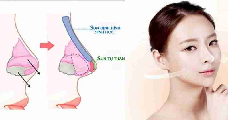 Nâng mũi xong có để lại di chứng về sau không?
