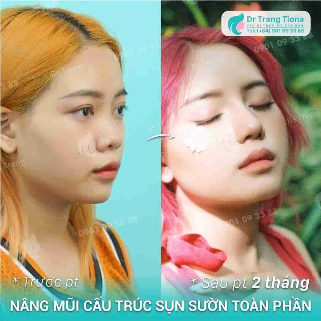Nâng mũi xong có để lại di chứng về sau không?