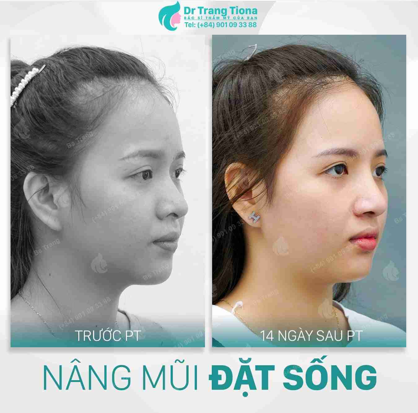 Phẫu thuật nâng mũi Sline giá bao nhiêu?