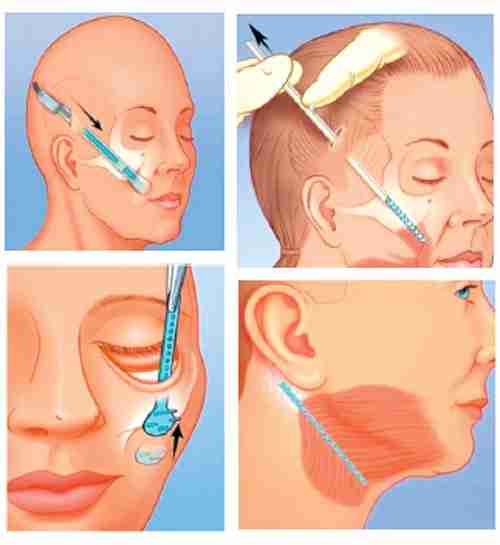 Giải đáp từ A-Z về phương pháp căng cơ nội soi