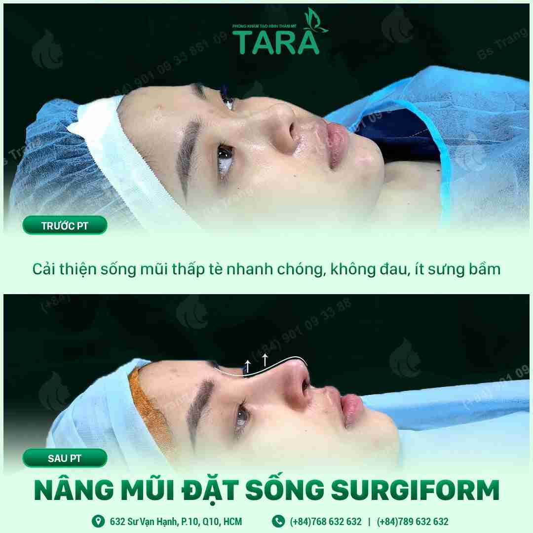 Quá trình phục hồi sau nâng mũi đúng cách