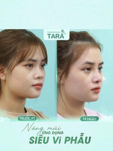 Review bác sĩ nâng mũi siêu vi phẫu Cái Hữu Ngọc Thảo Trang