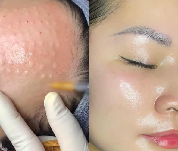 Review tiêm căng bóng: Kinh nghiệm của khách hàng