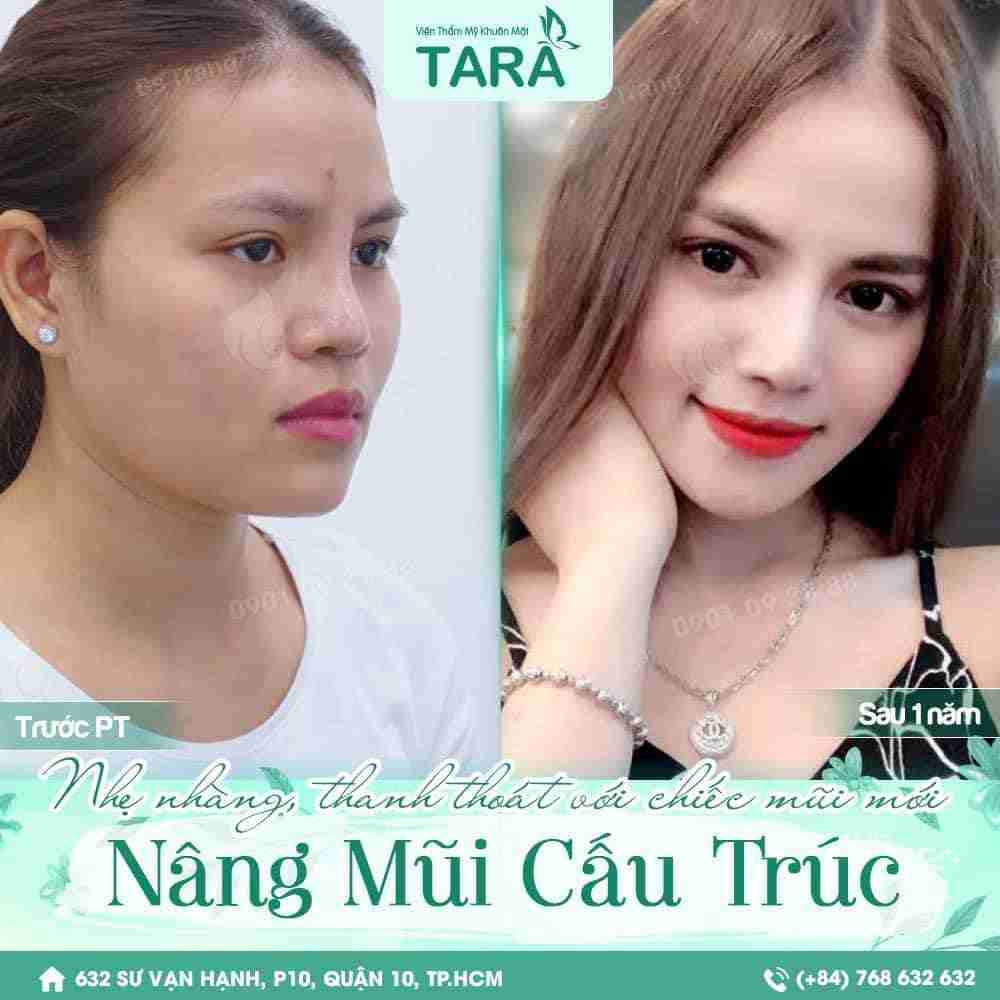So sánh nâng mũi cấu trúc và nâng mũi bán cấu trúc