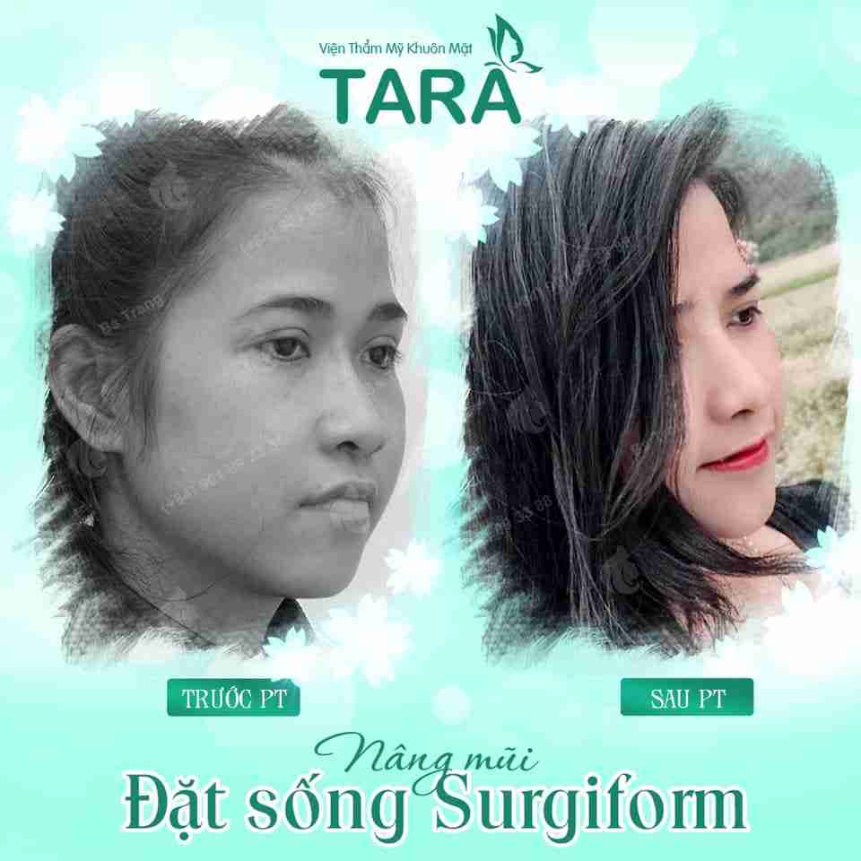 So sánh nâng mũi cấu trúc và nâng mũi bán cấu trúc