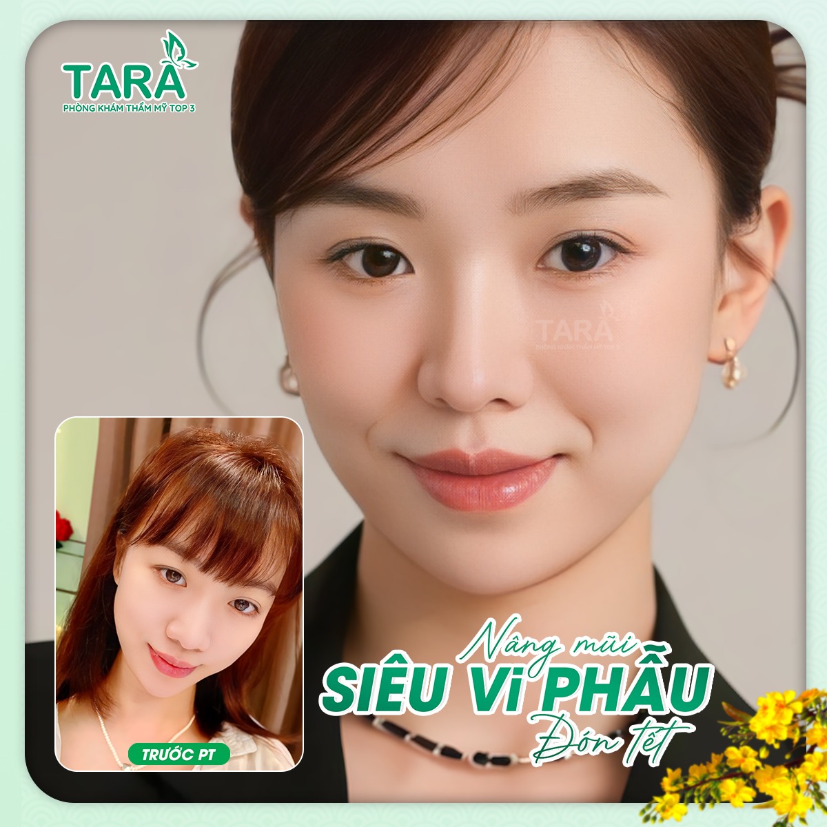 Sự thật về nâng mũi không đau tại TARA Beauty Clinic