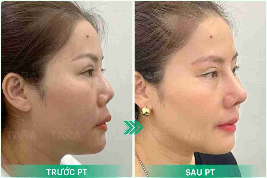 Sửa mũi hỏng nhiều lần có nguy hiểm không?