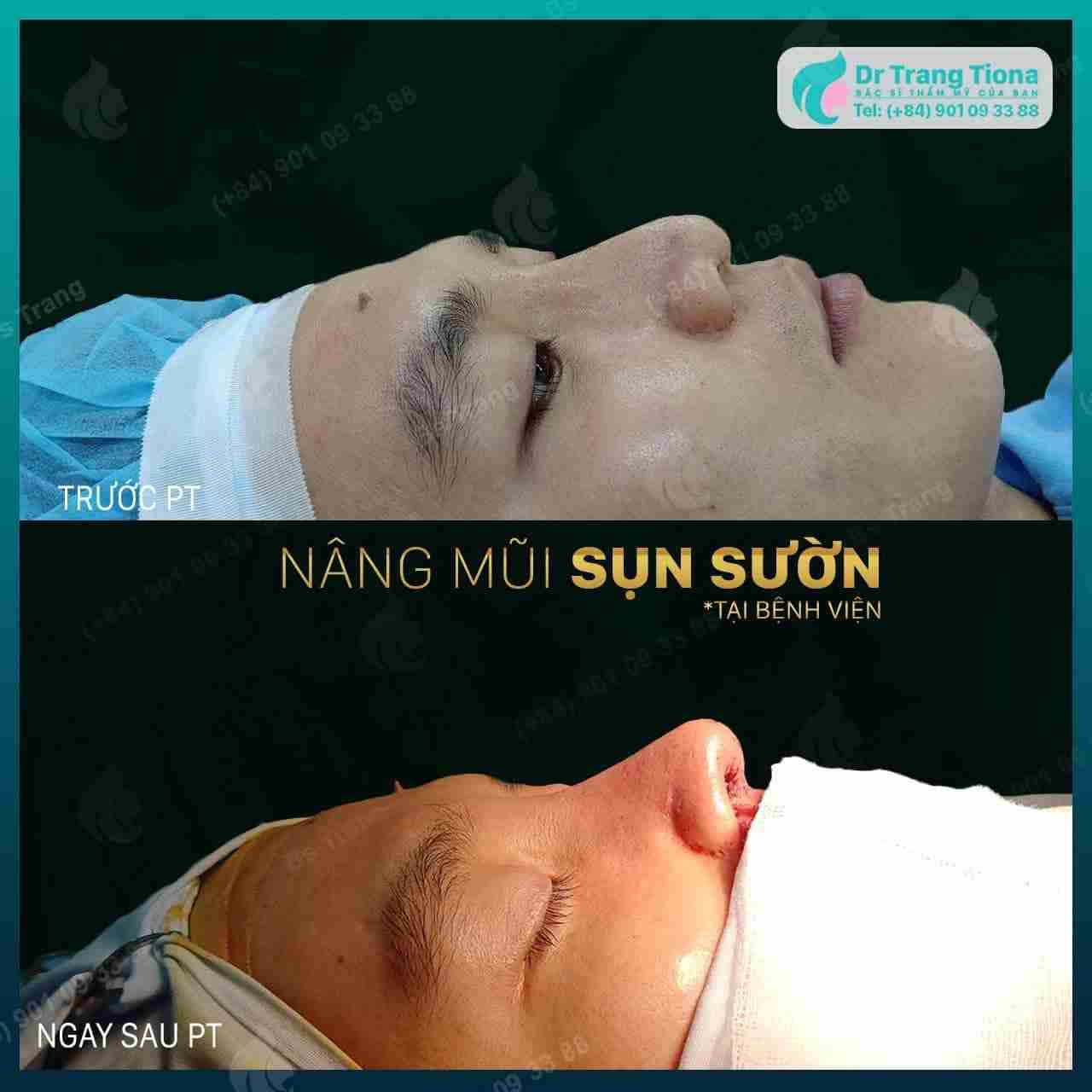 Sụn sườn được lấy từ đâu để nâng mũi?