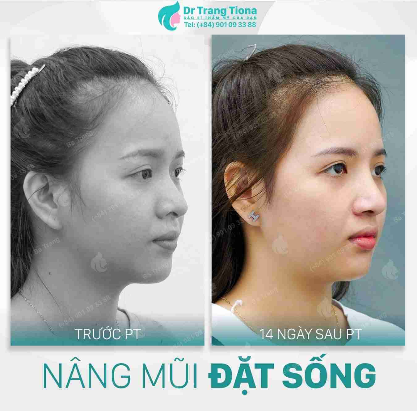 Tại sao không được nâng mũi quá cao và cảnh báo từ bác sĩ