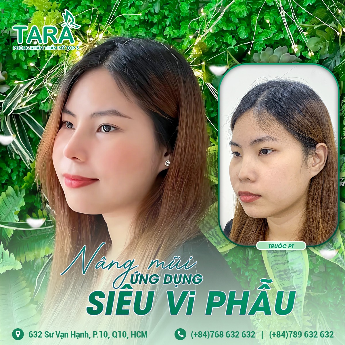 Tại sao nâng mũi ứng dụng đeo kính lúp siêu vi phẫu lại không đau?
