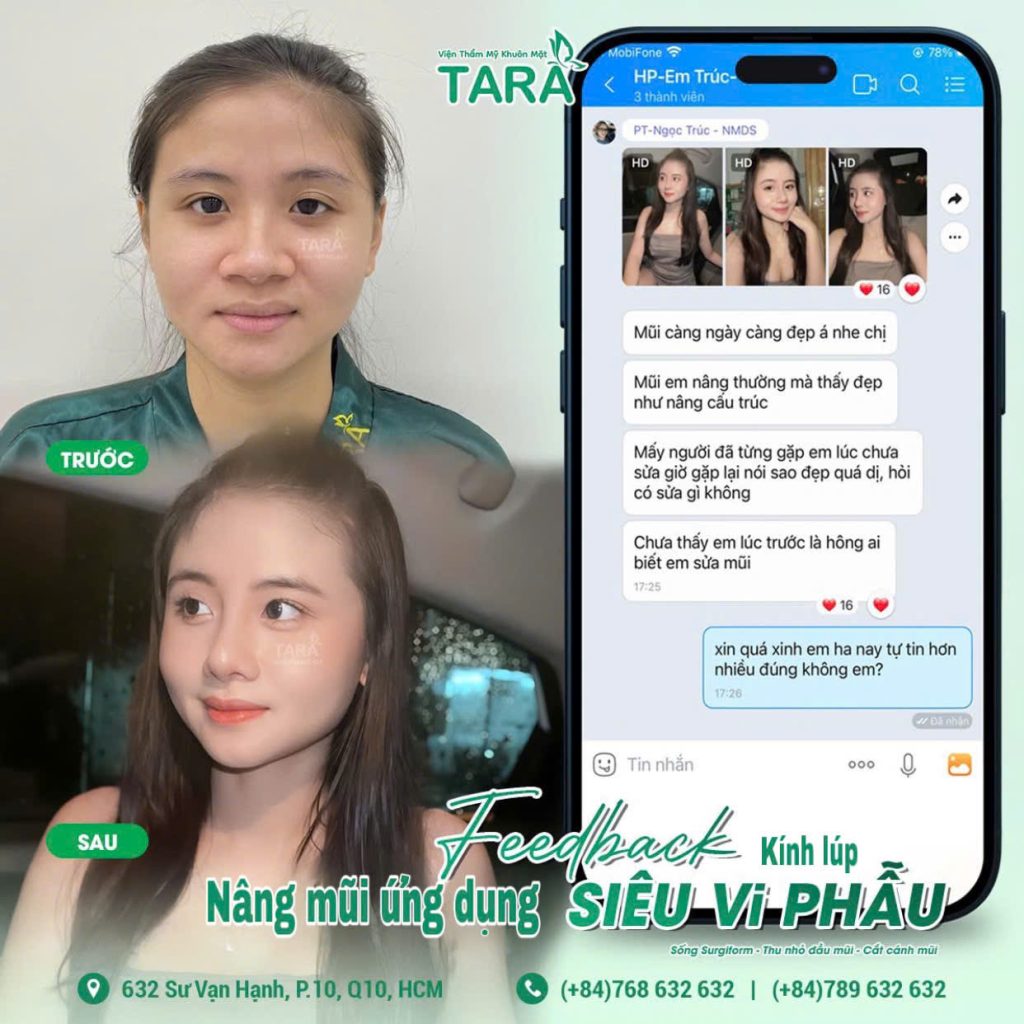 Tại sao nghệ sĩ chọn nâng mũi siêu vi phẫu?