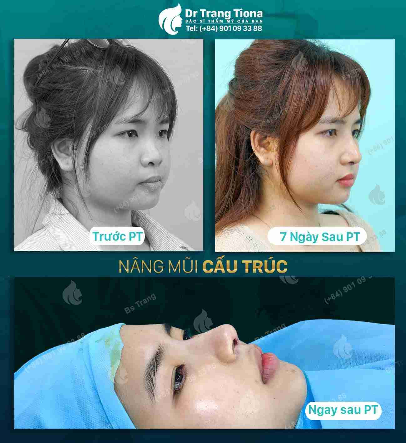Tại sao phải dùng nẹp định hình khi phẫu thuật nâng mũi?