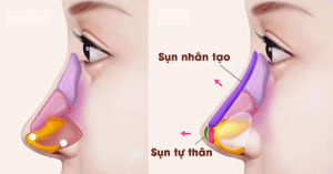 Toàn tập về nâng mũi (A-Z): So sánh các phương pháp và tại sao Siêu Vi Phẫu là xu hướng 2026
