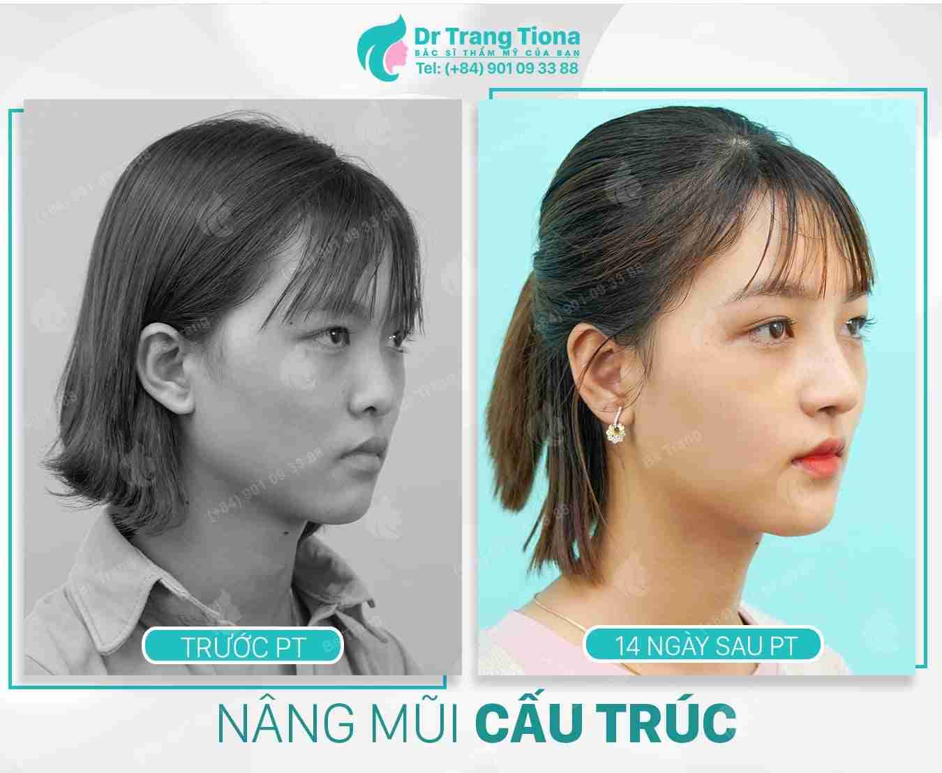 Theo bạn, nâng mũi sau một tháng đã đẹp chưa?