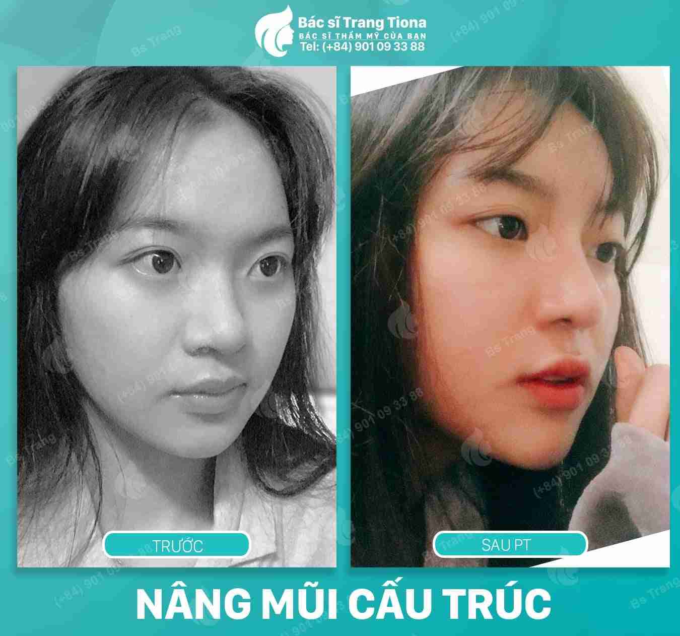 Theo bạn, nâng mũi sau một tháng đã đẹp chưa?