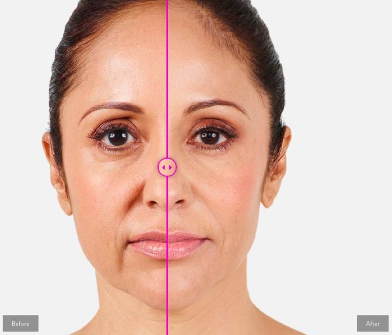 Tiêm filler Radiesse – Hiệu quả trẻ hoá gấp 3
