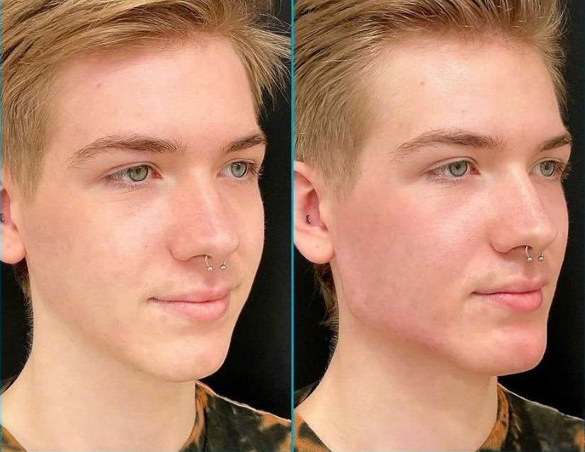 Tiêm filler Radiesse – Hiệu quả trẻ hoá gấp 3