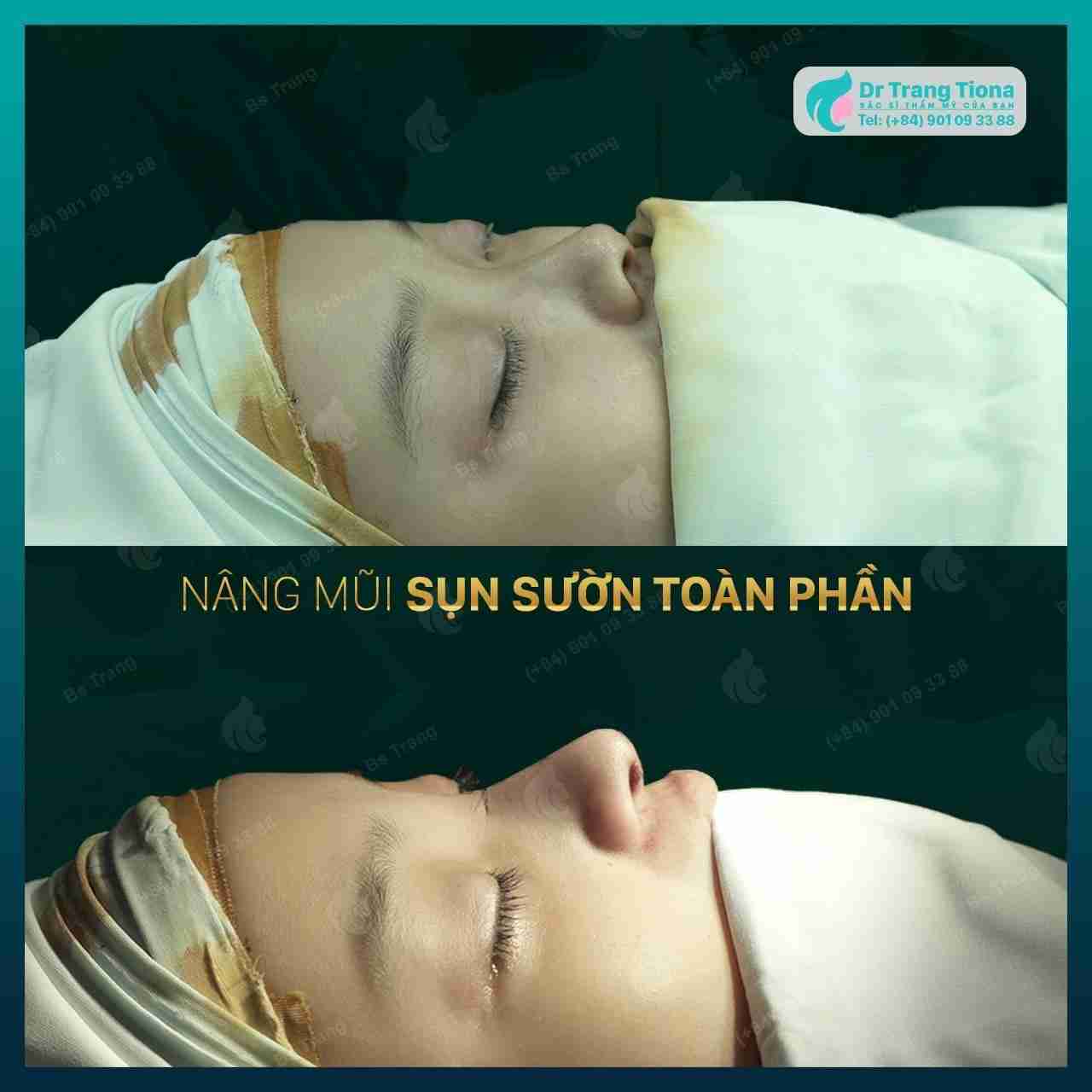 Tìm hiểu 8 loại sụn nâng mũi tốt hiện nay