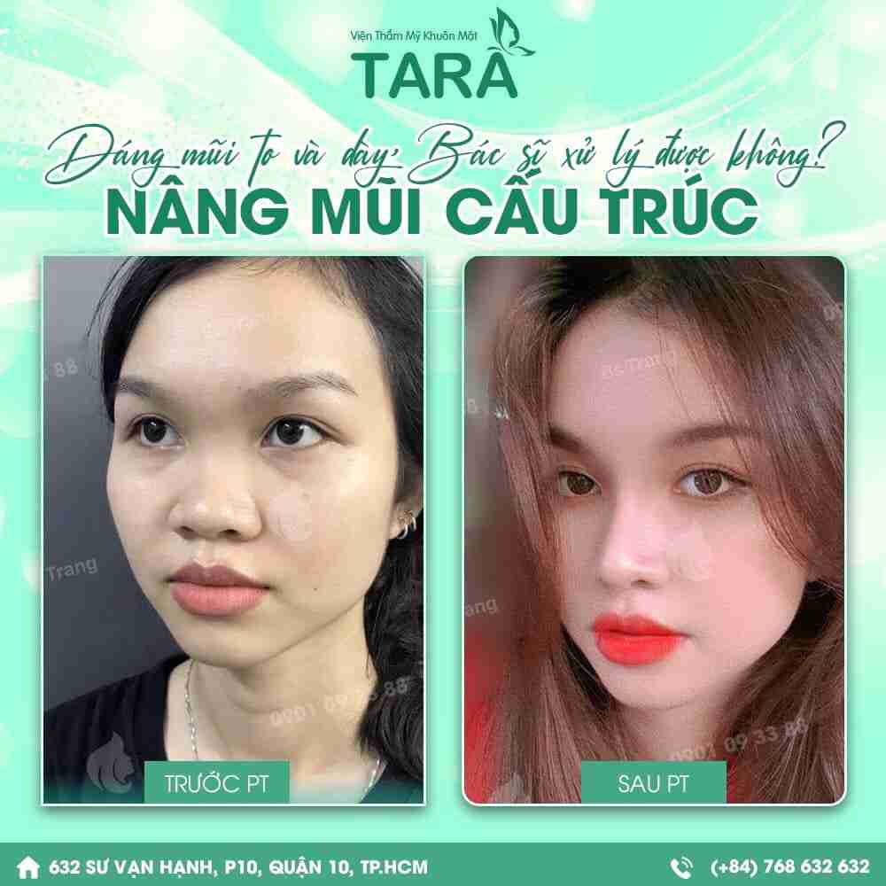 Toàn bộ về phẫu thuật nâng mũi cấu trúc: Phù hợp cho ai?