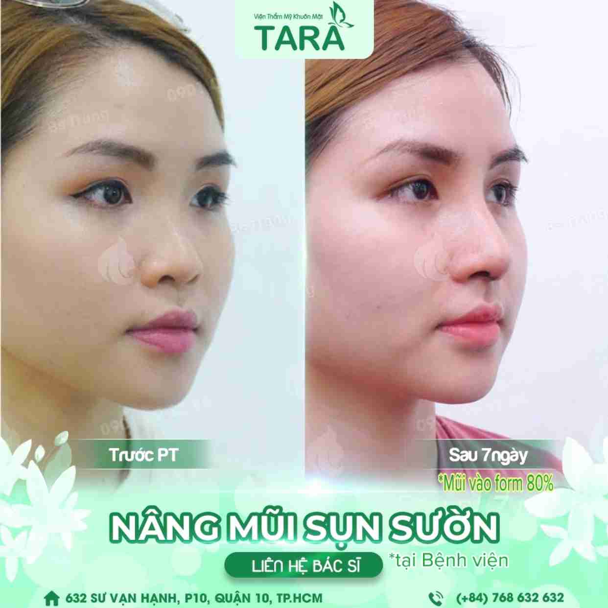 Toàn bộ về phẫu thuật nâng mũi cấu trúc: Phù hợp cho ai?