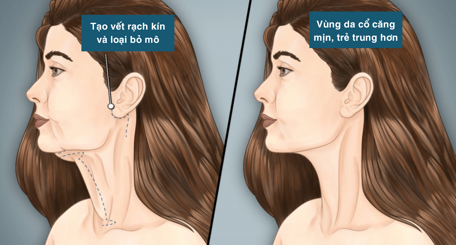 Tổng hợp 4 phương pháp căng da cổ hiện nay