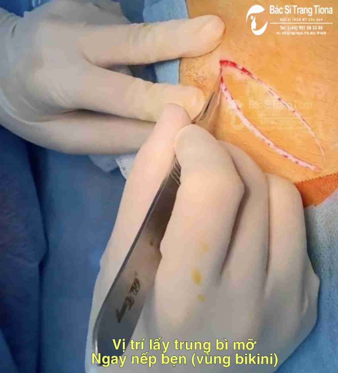 Tổng quan nâng mũi trung bì mỡ và giải đáp từ bác sĩ