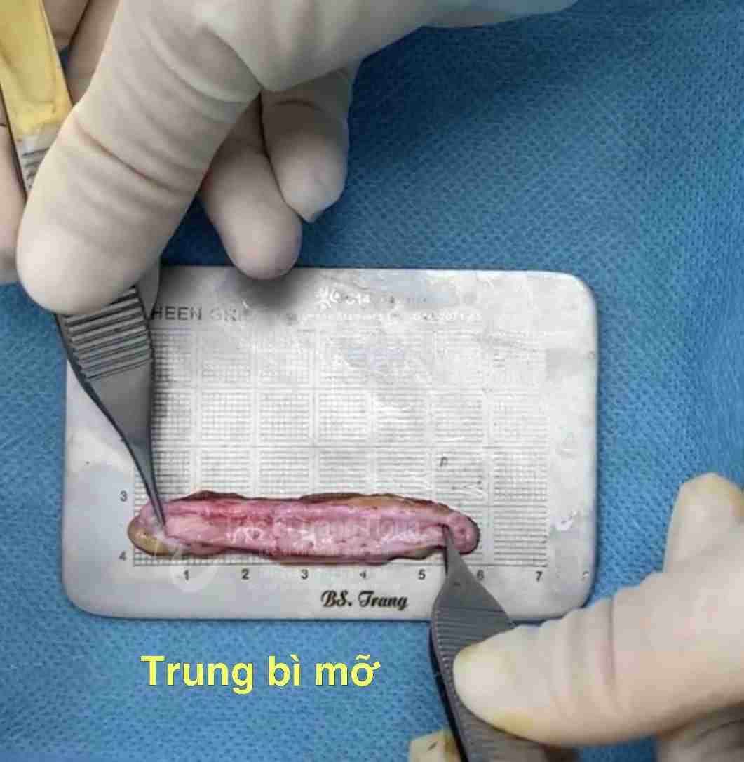 Tổng quan nâng mũi trung bì mỡ và giải đáp từ bác sĩ