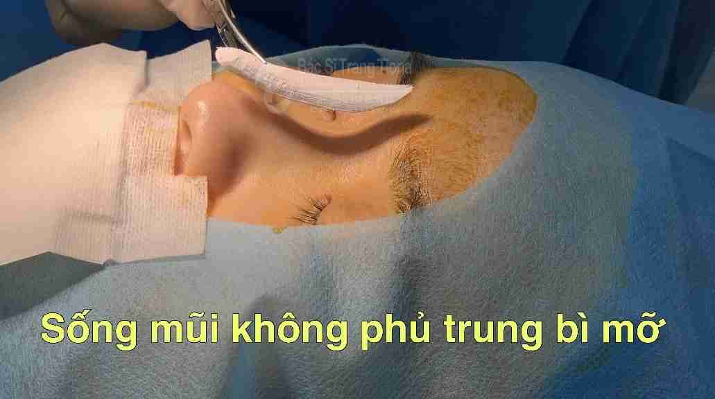 Tổng quan nâng mũi trung bì mỡ và giải đáp từ bác sĩ