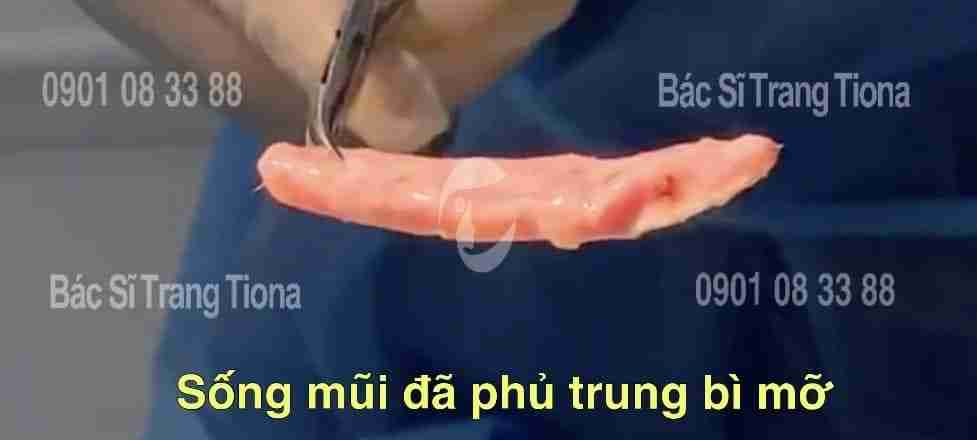 Tổng quan nâng mũi trung bì mỡ và giải đáp từ bác sĩ